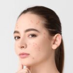 Manages Acne Sweet Almond Oil Coffee Scrub